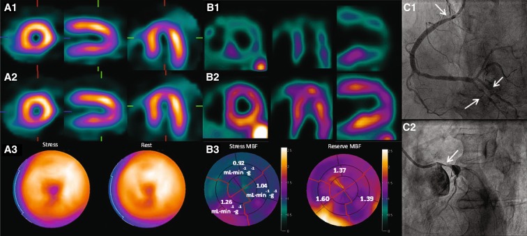 SPECT and PET images of heart-muscle blood flow