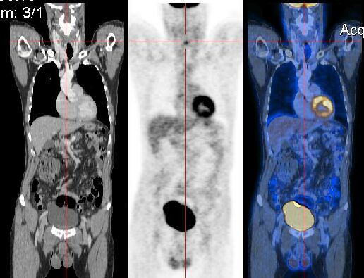 A fused PET and CT image
