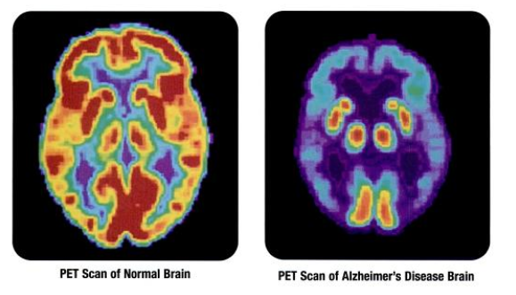 A comparison of brain PET images