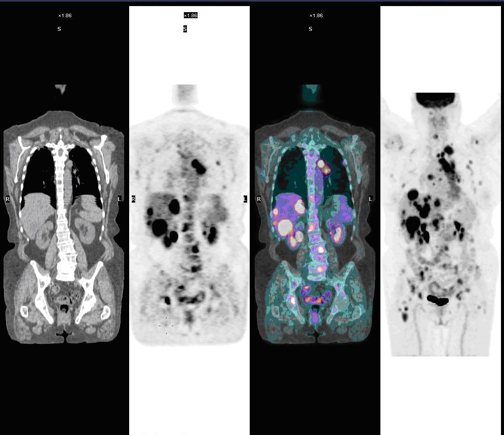 A clinical PET/CT scan of tumour disease